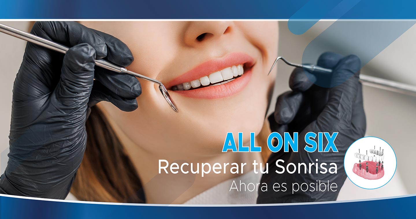 dental-solutions-all-on-six-implantes